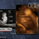 33-week-old baby in the womb