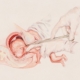 Diagram of partial-birth abortion procedure